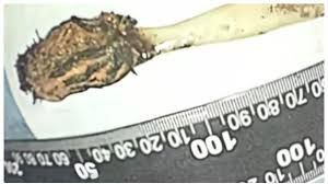 News Photo 1 - Other Countries - Otta Nottathil - tooth_brush_surgery_remove